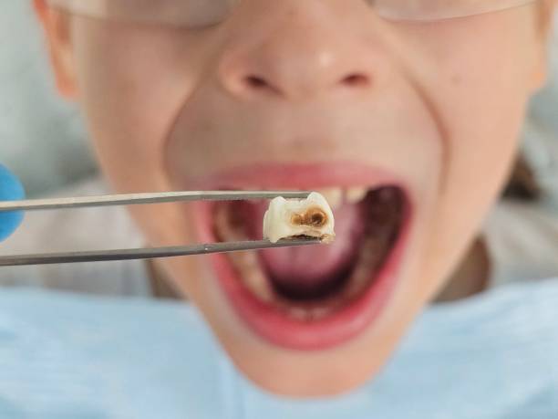 Best Emergency Dental Care for Abscessed Tooth in Stevenson Ranch, CA