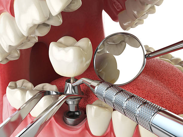 Best Emergency Root Canal Treatment in Stevenson Ranch, CA