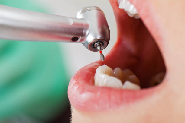 Best Emergency Dental Care for Abscessed Tooth in Stevenson Ranch, CA